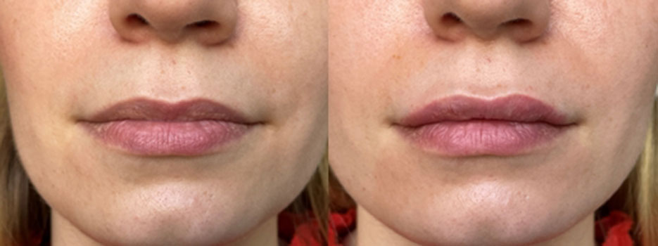 Injections lèvres / Avant / après