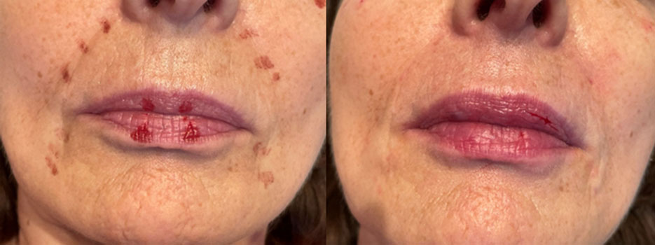 Injections lèvres / Avant / après